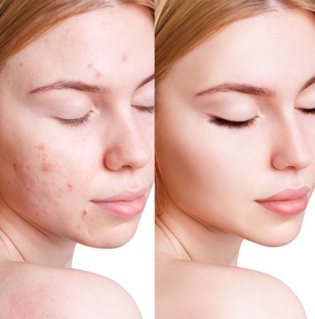 191892461 young woman without make up on face with acne on skin isolated on white background